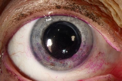 Atlas Entry - Punctate epithelial erosions (PEE) in exposure keratopathy