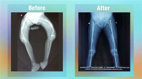 Children's Diaries : Successful Surgery for Osteogenesis Imperfecta ...