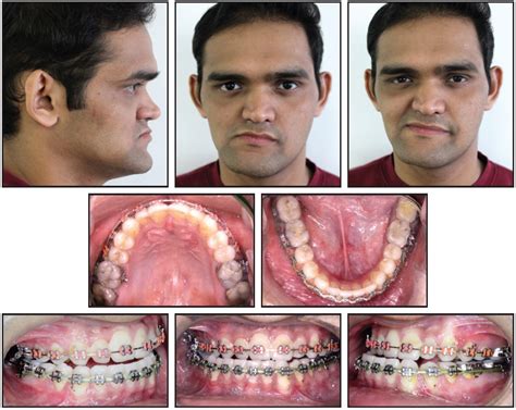 Treating Condylar Hyperplasia Like Condylar Hypoplasia