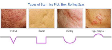 Fear of Acne Scarring? | IDS Aesthetics Singapore