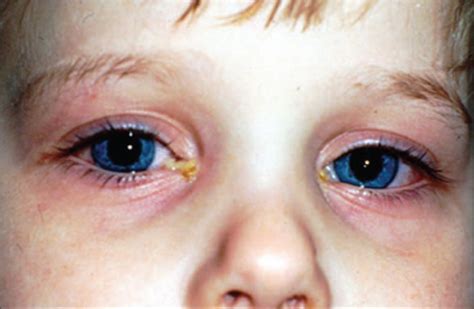 6 Things to Know About Conjunctivitis in Children (pink eye) – Things ...