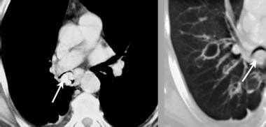 Lung Carcinoid Tumor Imaging: Practice Essentials, Radiography, Computed Tomography