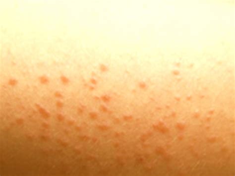 Chlorine Rash - Pictures, Causes and Treatments