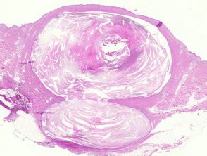 Epidermoid cyst pathology | DermNet