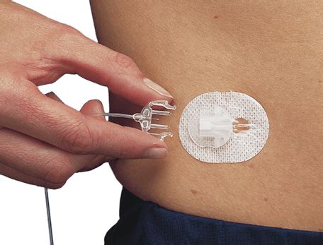 Infusion Sets For Insulin Delivery | Medtronic Diabetes