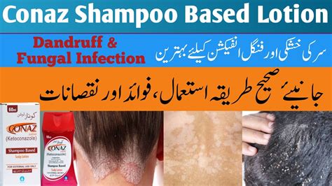 conaz | Conaz Shampoo Benefits in urdu | conaz lotion shampoo | conaz ...