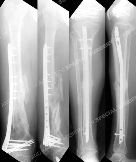 Compound Femur Fractures