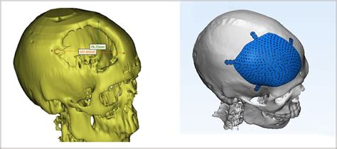 Cranial Implants - 3DIncredible