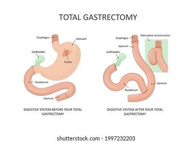 Total Gastrectomy Scar