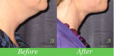 Smartlipo Triplex Neck before and after photo by Abloom Med Spa. | Smart lipo, Med spa, Laser ...