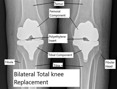 Bilateral Knee Replacement (Simultaneous) - Complete Orthopedics