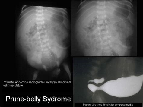 Prune Belly Syndrome Radiology