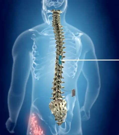 High-Frequency Spinal Cord Stimulation for Newburyport, Danvers and Gloucester, MA | Pain ...