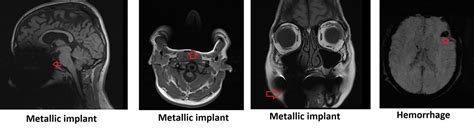 Metal \Titanium Artifact MRI | Magnetic Susceptibility Artifact MRI