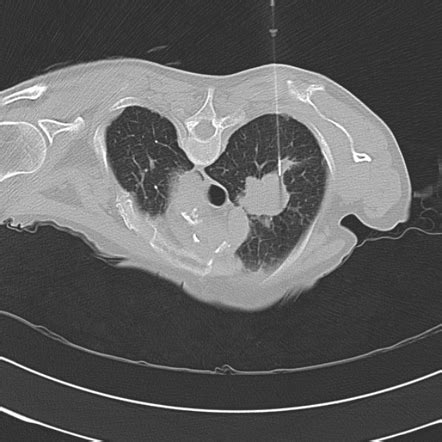 CT guided lung biopsy: deep location | Image | Radiopaedia.org