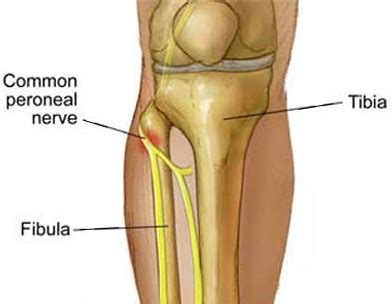 Peroneal Nerve Floss | Chiropractor Bloomington IL| Shepard Pain ...