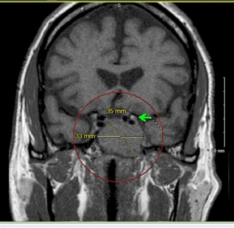 Coronal T1-weighted MRI sequence showing hypointense 35 mm × 33 mm... | Download Scientific Diagram