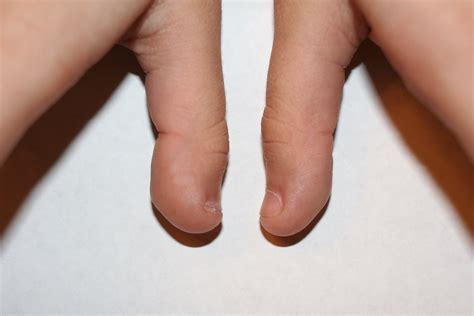 Clubbed thumb - wikidoc