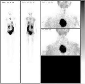 99m Tc-MIBI Whole Body Scan (Anterior and Posterior views) at 2 hours... | Download Scientific ...