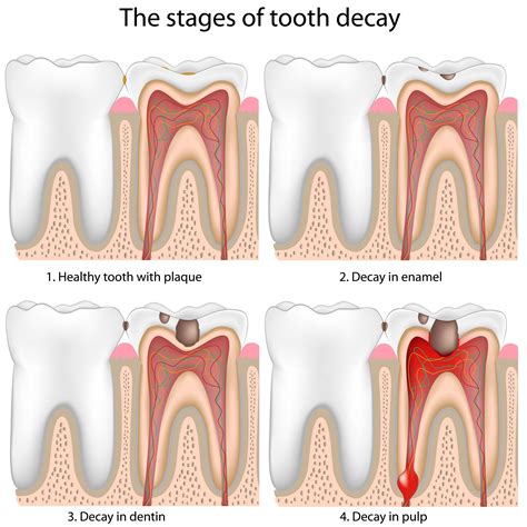Stages of Tooth Decay - Troy, MI - Restorative Dentistry