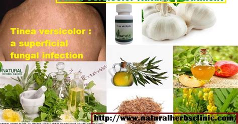 Tinea Versicolor Natural Treatment