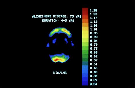 Pet Scan Of Brain In Alzheimer's Disease Photograph by National ...