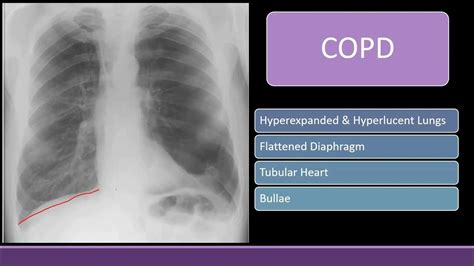 Black lung field: COPD, Pneumothorax & Bullae on Chest X-ray - YouTube