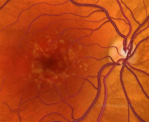 Drusen in macular degeneration medical illustration