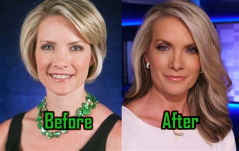 Dana Perino Plastic Surgery: Facelift, Nose Job, Teeth, Before-After ...