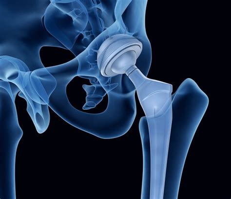 Dislocation following hip replacement surgery - Dr. Anthony Spriggins