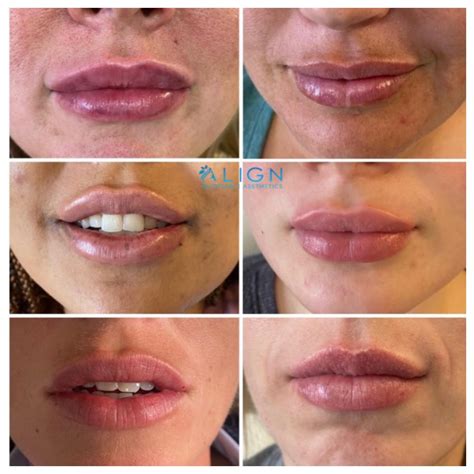 FAQ: Lip Injections | Align Injectable Aesthetics