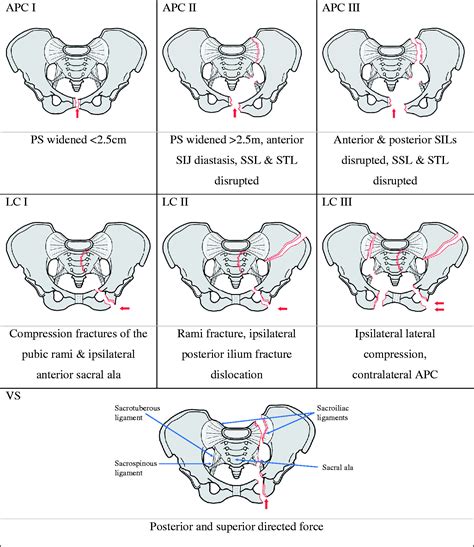 An overview of the key principles and guidelines in the management of pelvic fractures - Ahmed M ...