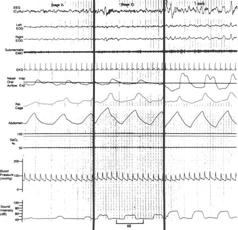 Full nocturnal polysomnogram illustrating progressive increase in the... | Download Scientific ...