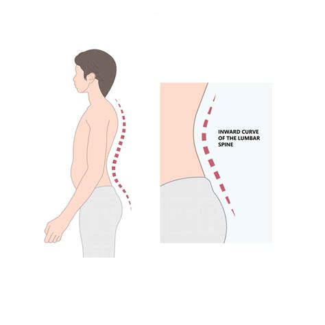 Hyperlordosis- Should It Worry You? We Give You 4 Exercises