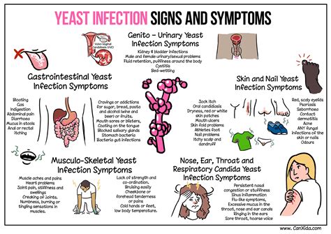 federación Paja ballet candida fungal infection symptoms famoso Infrarrojo Ocho