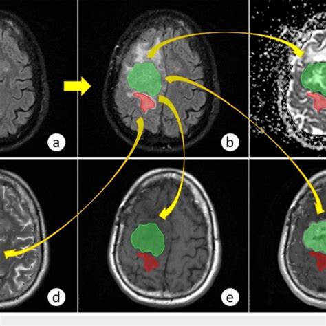 (PDF) Multiparametric Magnetic Resonance Imaging in the Assessment of Primary Brain Tumors ...