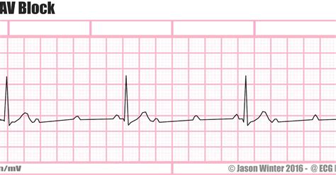 ECG Educator Blog : 3rd Degree AV Block