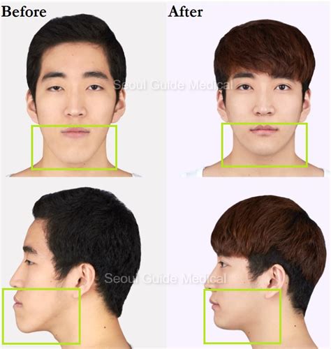 Before And After Double Jaw Surgery - Seoul Guide Medical