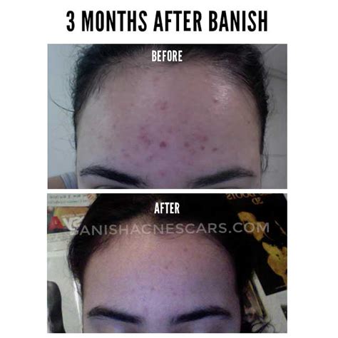 Results from Banish and my Struggle With Acne