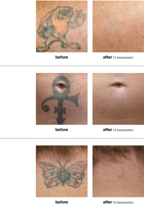 Discover 75+ picosecond laser tattoo removal latest - in.cdgdbentre