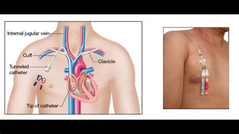 Temporary Hemodialysis Catheter Code