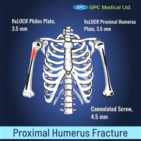 Proximal Humerus Fractures Anatomy And Classification - vrogue.co