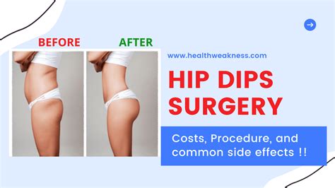 Hip Dips Surgery In 2024: Costs, Procedure, And Common Side Effects