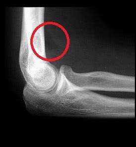 Supracondylar fracture - WikEM