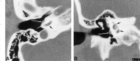 Glomus Tympanicum Tumor | Semantic Scholar