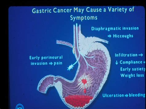 Gastric cancer - Cancer Therapy Advisor