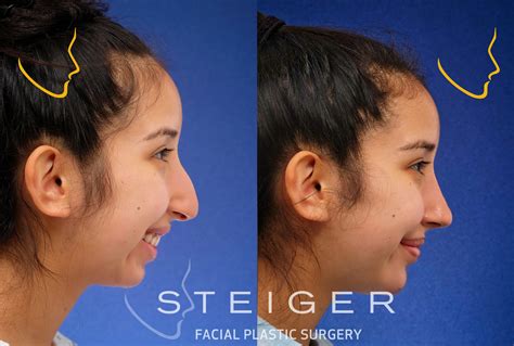 Rhinoplasty Before and After Photos