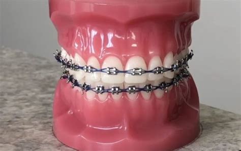 Why Use Black Braces? - Keep your Dental Health in perfect shape!