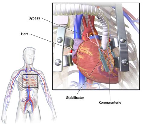 Bypass: Definition, Gründe, Ablauf der Operation | praktischArzt