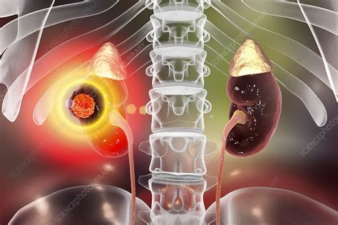 Kidney cancer treatment, conceptual illustration - Stock Image - F021/3599 - Science Photo Library